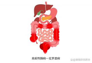 什么人容易得克罗恩病(克罗恩病为什么叫美人病)