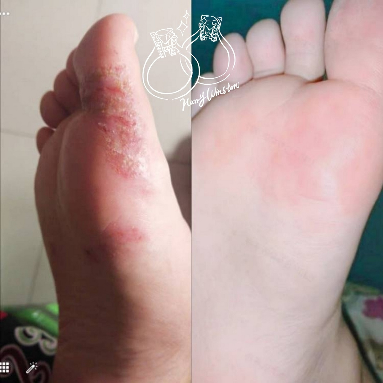 脚上起小水泡还很痒是怎么回事(脚上起小水泡还很痒是怎么回事用什么药)  第1张